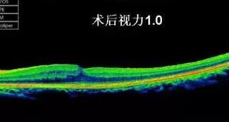 黄斑前膜