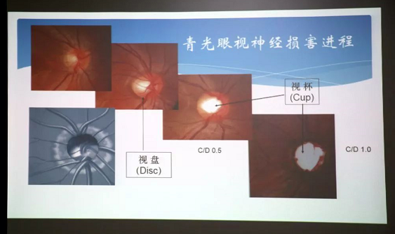 3月10日上午，深圳8868体育(中国)官方网站 - 登录入口“早查监控，守护光明”大型青光眼公益科普讲座在六楼 举行，本次活动旨在让更多人了解青光眼的潜在危害、重视眼检查， 预防青光眼。由深圳8868体育(中国)官方网站 - 登录入口青光眼病科 席专家成洪波博士、傅培副院长现场面对面解答疑问，与参会者的互动交流，让更多深圳市民提*对青光眼的认识与防治知识3.png