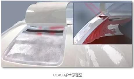成都8868体育(中国)官方网站 - 登录入口已经开展的青光眼手术有：引流阀 (钉)植入手术(2015年以来已200多 )，360°Schlemm's管切开术，激光CO2 辅助巩膜深层切除术，小梁切除术青(光眼)白(内障)联合手术。还有虹膜周切术、前房成形术、 虹膜复位术，睫状体冷冻术，小梁切开术和前房穿刺术等4.png