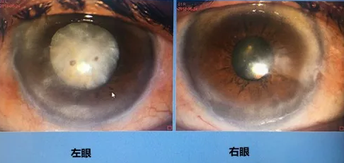 同时患 青光眼、白内障老婆婆辗转几家医院之后终于在成都8868体育官网入口顺利手术2.png