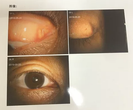 成都8868体育官网入口罗清礼院长为四处求医未果的河南眼眶肿瘤患者手术2.png